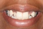 image of teeth before six month braces in mt pleasant sc