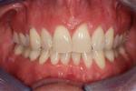 image of teeth before six month braces in mt pleasant sc