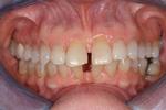 image of teeth with gaps before six month braces mt pleasant sc