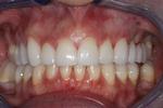 image of the same teeth after dental veneers in mt pleasant sc