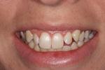 image of teeth before six month braces in mt pleasant sc