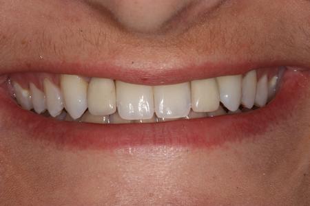 image of the same teeth after Maryland bridges in mt pleasant sc