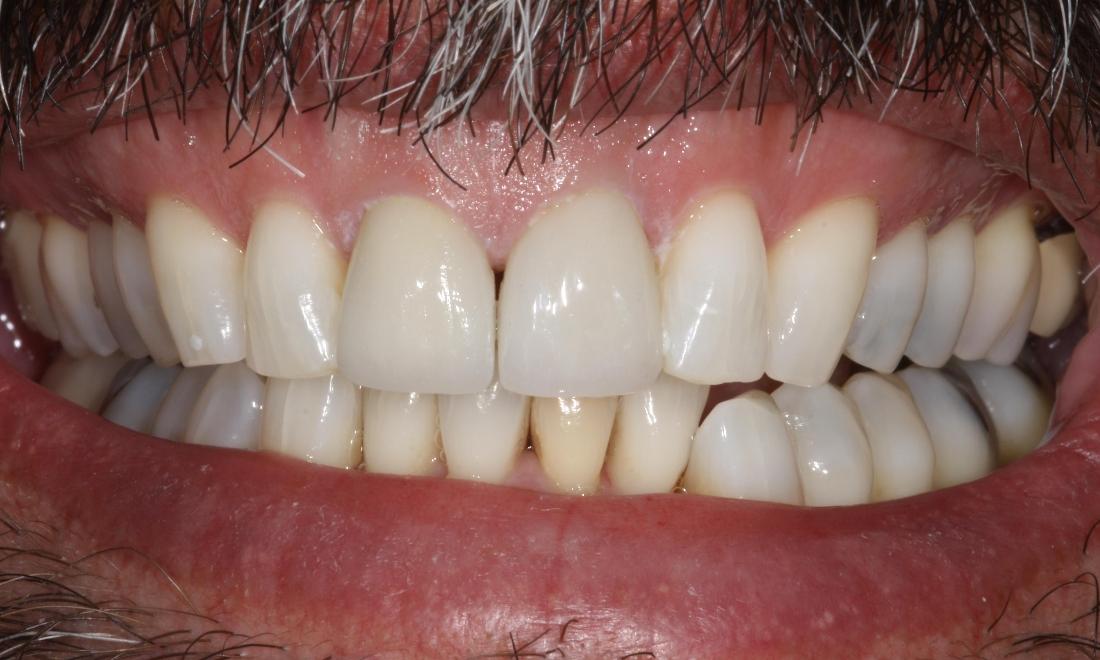 picture of same teeth after veneers and bleaching in mt pleasant sc