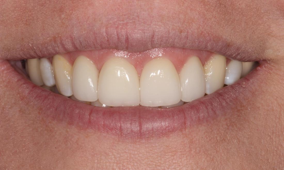 image of same teeth after dental veneers in mt pleasant sc
