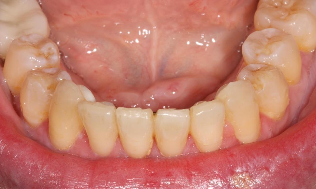 image of teeth after six month braces in mt pleasant