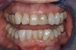 Image of teeth before porcelain veneers in mt pleasant sc