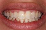 image of the same teeth after six month braces in mt pleasant sc