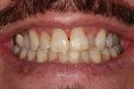 image of teeth before six month braces in mt pleasant sc