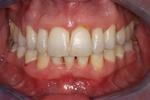 image of the same teeth after six month braces in mt pleasant sc
