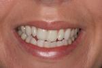 image of teeth before six month braces in mt pleasant sc
