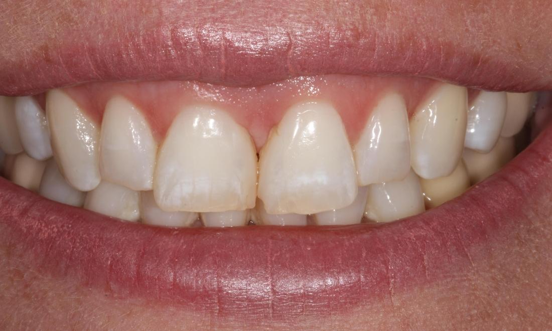 image of teeth before dental veneers