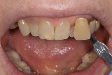 image of teeth before deep bleaching mt pleasant