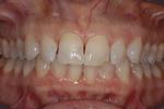 image of teeth before six month braces in mt pleasant sc