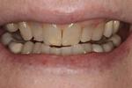 image of teeth before deep bleaching mt pleasant sc