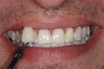 image of the same teeth after KOR whitening mt pleasant sc