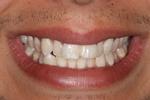 picture of teeth before six month braces mt pleasant sc