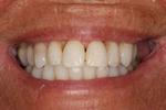 image of the same teeth after six month braces in mt pleasant sc