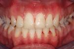 image of teeth after six month braces | mt pleasant sc