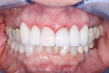 image of teeth after porcelain veneers in mt pleasant sc