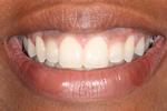image of the same teeth after six month braces in mt pleasant sc