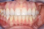 image of same teeth after six month braces in mt pleasant sc
