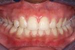 image of same teeth after six month braces in mt pleasant sc
