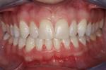 image of teeth after six month braces in mt pleasant sc