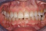 image of teeth with gaps after six month braces mt pleasant sc