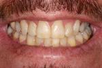 image of same teeth after six month braces in mt pleasant sc