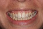 image of same teeth after six month braces in mt pleasant sc
