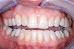 image of lower teeth after six month braces mt pleasant sc