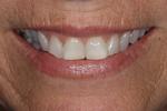 image of teeth before cosmetic crowns mt pleasant sc