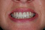 image of teeth after dental veneers in mt pleasant sc