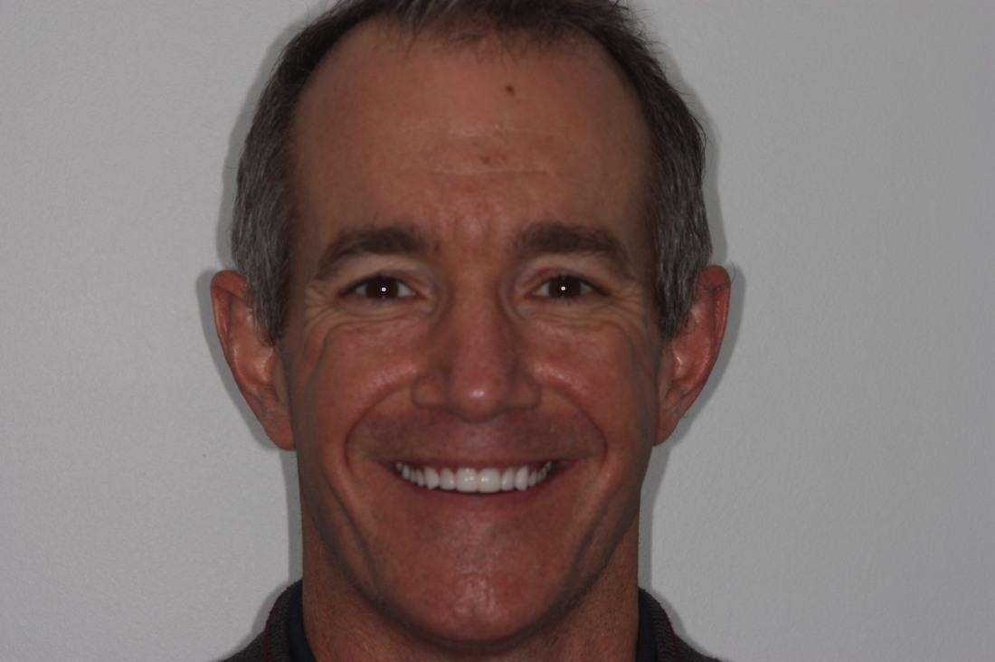 After Picture of a patient after cosmetic procedure in mt pleasant sc