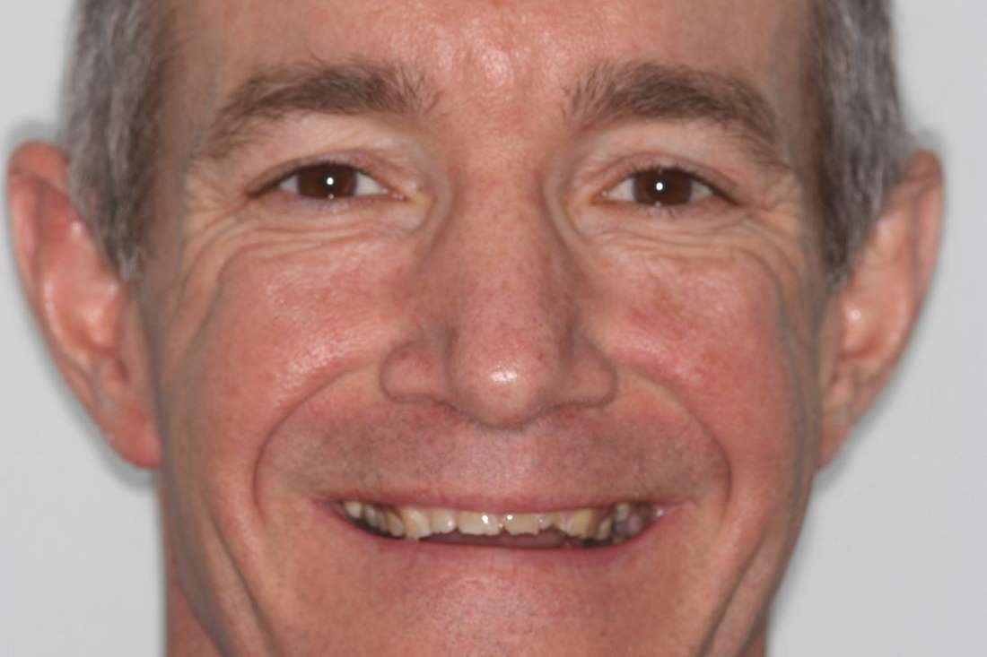 Before Picture of a patient with worn out teeth in mt pleasant sc