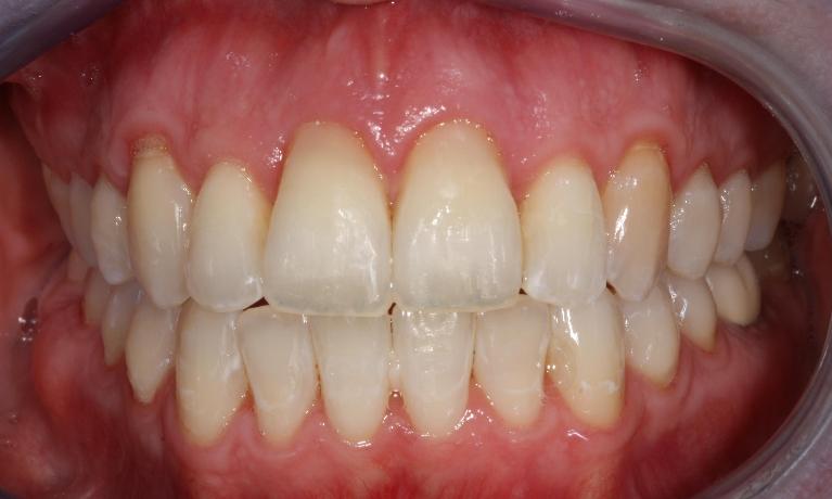 image of the same teeth after 6 month braces
