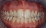 image of the same teeth after six month braces in mt pleasant sc