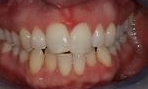 image of teeth before six month braces in mt pleasant sc