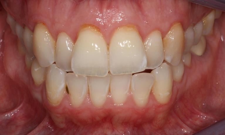 image of teeth before six month braces