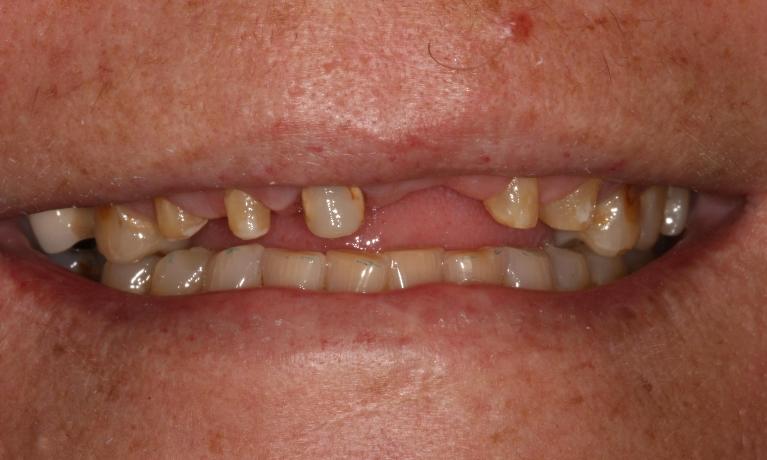 A-Beautiful-Affordable-Solution-After-a-Dental-Emergency-Before-Image