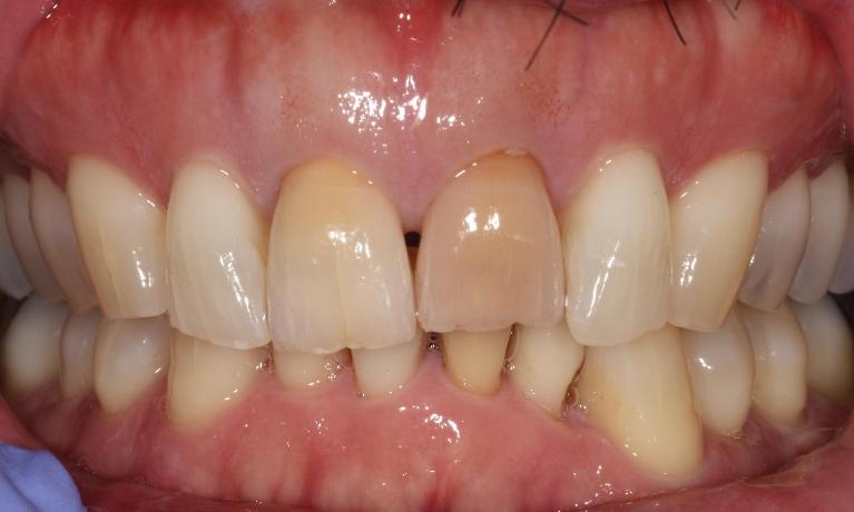 A-Whiter-Smile-Without-Veneering-Every-Tooth-Before-Image