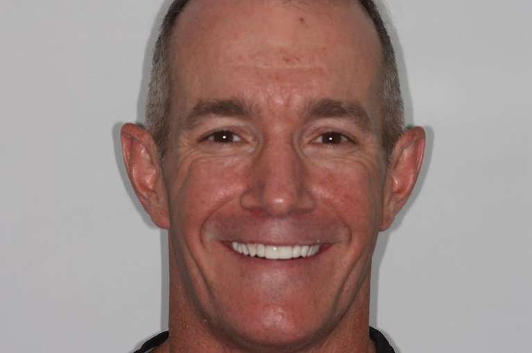 Before-and-After-Restoring-Confidence-with-Dental-Crowns-After-Image