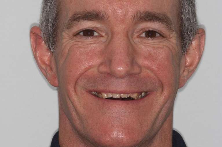 Before-and-After-Restoring-Confidence-with-Dental-Crowns-Before-Image